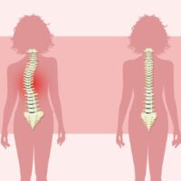 Active Life Chiropractic Vertebral Subluxation