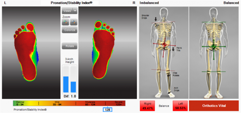 Diagram of Pronation Stability Index